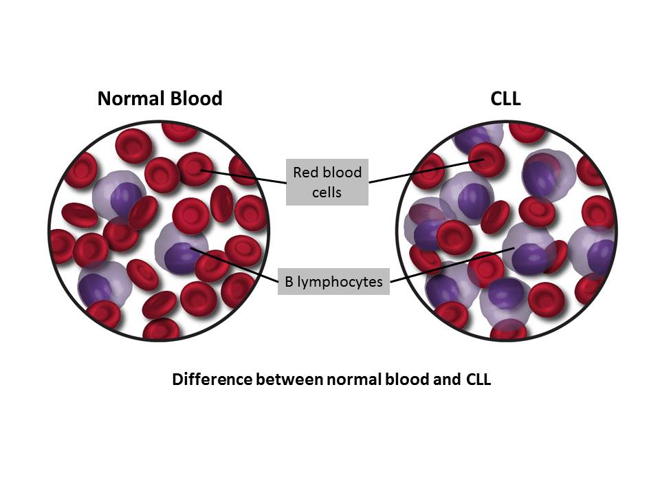 Normal Blood & CLL Normal Blood & CLL